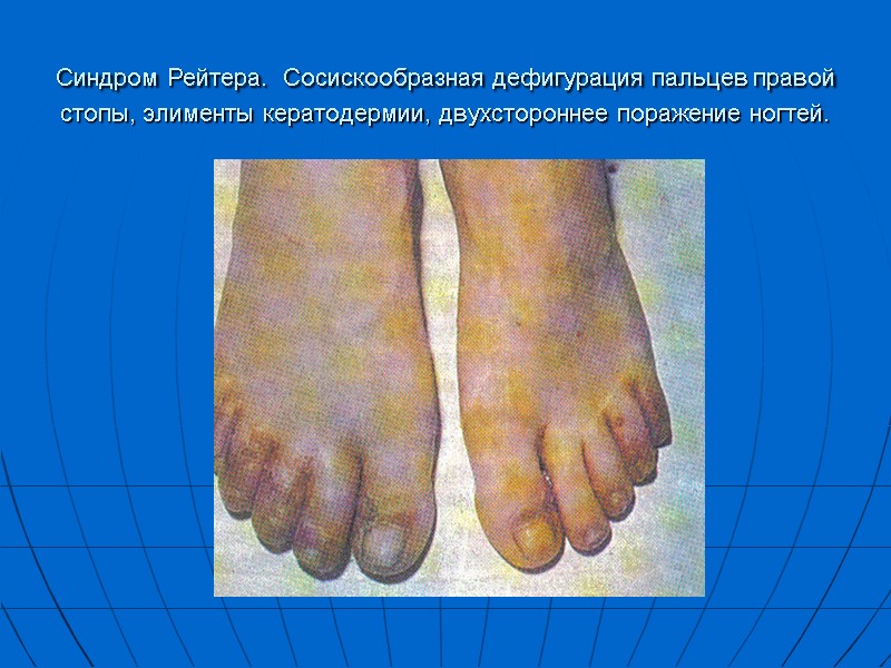 Синдром Рейтера. Сосискообразная дефигурация пальцев правой стопы, элименты кератодермии, двухстороннее поражение ногтей.